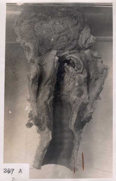 Epitelioma, Departament d'Anatomia Patològica del Dr. D. Ferrer Cagigal, 1927